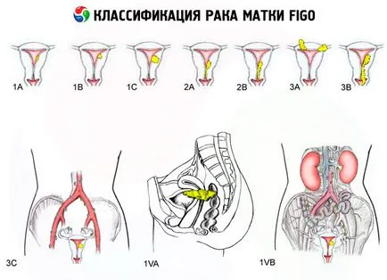 cancer uterin cauze, simptome, diagnostic, tratament, competente pentru sanatate pe ilive