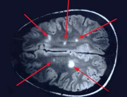 Scleroza multipla privind caracteristicile RMN si diagnosticul sclerozei multiple