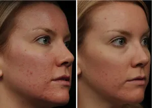 comentarii Roaccutane, instrucțiuni de utilizare, preț, analogi, efecte secundare