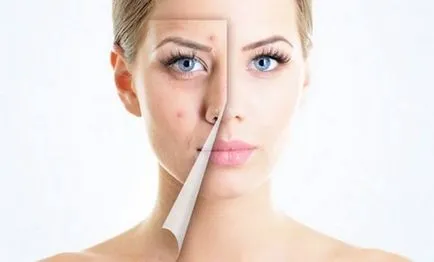 Rf facelift ce este, recenzii, contraindicații (fotografii înainte și după)