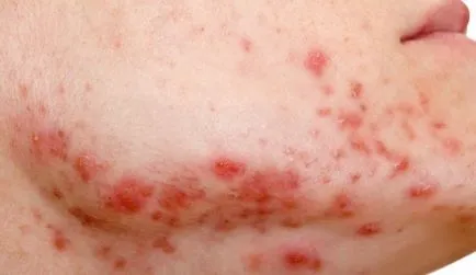 remedii populare de tratament rozacee in casa (acnee rozacee) Rozacee tratament remedii populare la domiciliu