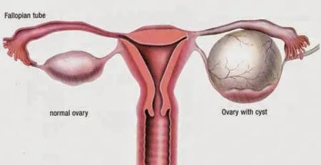 chist ovarian seroasă