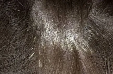 Exfoliantă scalpului de ce este puternic decojite copilul ce să facă