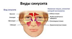Simptome și tratament etmoidita și agenți patogeni și gaymoroetmoidita cauze, clasificare și semne