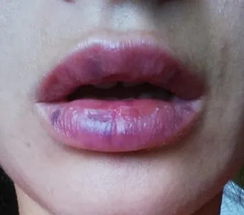 Vânătăi după acid hialuronic augmentarea buzelor; tratamentul mijloacelor hematom farmacie,