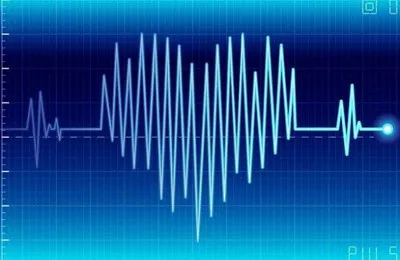 aritmie sinusală pe ECG 1