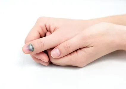 zdrobit Prost degetul pe de o parte ce să facă acasă, cât de repede vindecare