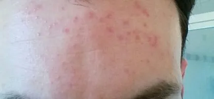 Erupții cutanate pe frunte copilului și cauzele adulte (copil) Erupții cutanate pe frunte copilului și cauzele pentru adulți