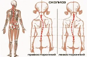 Tipuri de Scolioza, cauze, semne, simptome și tratament (dreapta-stanga scolioza tratament clasificare deformare spinarii a simptomelor de diagnostic terapie fizica masaj spate) Tipuri de Scolioza, cauze, semne, simptome și tratament