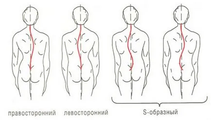 Tipuri de Scolioza, cauze, semne, simptome și tratamentul (specii) Tipuri de Scolioza, cauze, semne, simptome și tratament