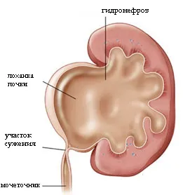 Rinichi pelvis ce este