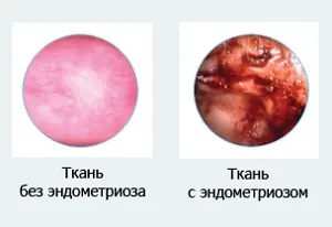 Uzi endometrioza Uzi endometrioza