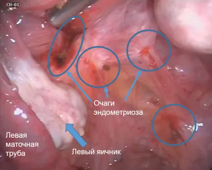 Uzi endometrioza Uzi endometrioza