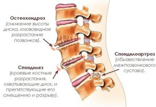 Spondiloza ce este