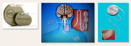Stimulatori nervului vag in nipni ei (chirurgie spinarii) Stimulatori nervului vag in nipni ei
