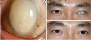 Tatuaj pe globul ocular