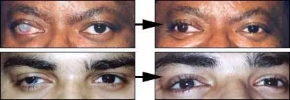 Tatuaj pe globul ocular