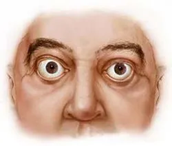 thyreostatics