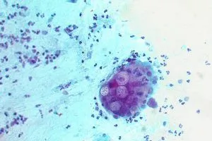 ochi Trachoma
