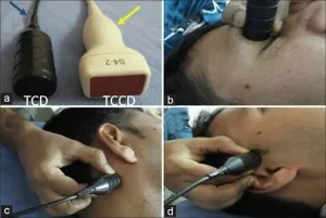 Doppler transcraniană indicatii vasculare cerebrale si tehnica
