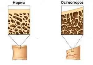Efectele Histerectomia ale operațiunii
