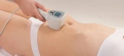 Eliminarea vergeturilor cu laser - dacă laser poate elimina vergeturile
