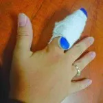 Contuzia degetul asupra simptomelor de mână, cauze, tratament, foto (simptome) Contuzia degetul asupra simptomelor de mana, cauze, tratament, fotografii