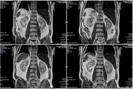 urografie excretor renale, intravenos, obiectiv turistic (cantități mari de apă) Renale urografie excretor, intravenos, obiectiv turistic