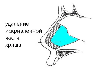 turbinates Vasotomy, submucoasă nazal rezecția