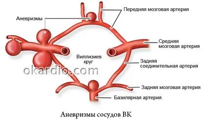 Varianta cercului de Willis ceea ce inseamna simptome si diagnostic