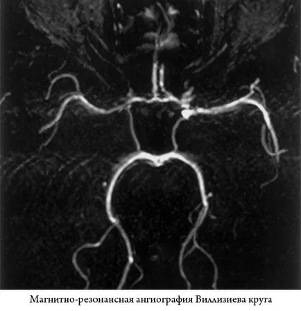 Varianta cercului de Willis ceea ce inseamna simptome si diagnostic