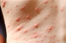 Varicela simptomelor copii și tratament, imagine de varicela (copii) Varicela simptomelor copii și tratament, fotografie varicelă