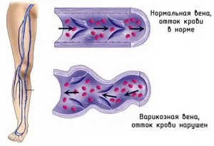 stazei venoase la nivelul picioarelor si simptomele pelvine si tratamentul (simptomelor) stază venoasă în picioare și pelvis simptome și tratament