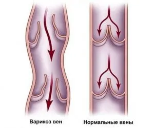 stază venoasă în picioare și pelvis simptome și tratament (pelvis) stază venoasă în picioare și pelvis simptome și tratament