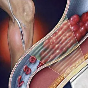 congestie venoasă în cap, picioare, pelvis și ale plămânilor (congestie) congestie venoasă în cap, picioare, pelvis și plămânii