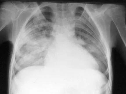 vaselor cerebrale stazei venoase, pelvis, picioare, și plămâni