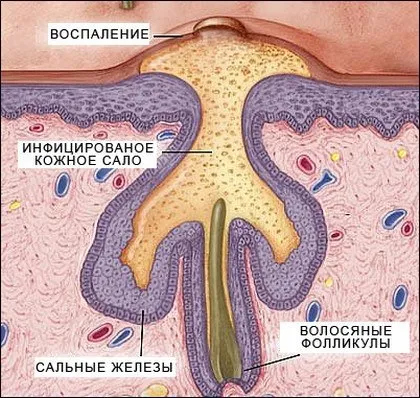 Tipuri de acnee descrierea și caracteristicile principalelor tipuri de acnee - Care sunt principalele diferențe