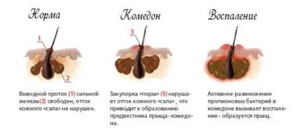 Tipuri de acnee descrierea și caracteristicile principalelor tipuri de acnee - Care sunt principalele diferențe