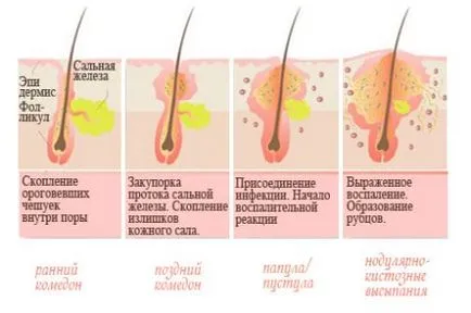 Tipuri de acnee descrierea și caracteristicile principalelor tipuri de acnee - Care sunt principalele diferențe