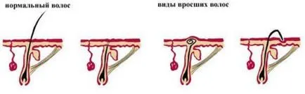 Crească părul după îndepărtarea părului - ce să facă (părul) Crească părul după îndepărtarea părului - ce să facă