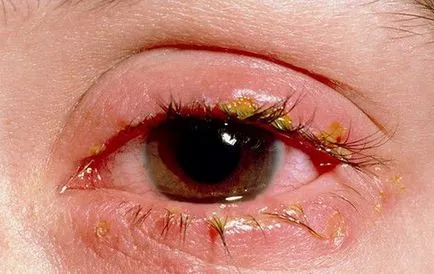 Inflamația a pleoapei modul de a trata tratamentul pleoapelor superioare și inferioare într-un copil (tratament) Inflamația a pleoapei modul de a trata tratamentul pleoapelor superioare și inferioare într-un copil