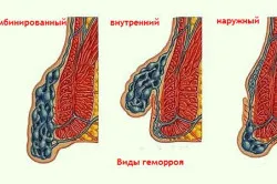 hemoroizi inflamati care fac hemoroizi inflamati care fac
