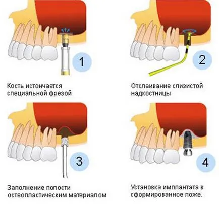 Înlocuirea tuturor dinților pe implanturi (implanturi) Înlocuirea tuturor dinților pe implanturi