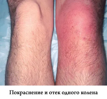 Lichidul din cauzele articulației genunchiului tratament, simptome, diagnostic (comun) Lichidul din cauzele articulația genunchiului și de tratament, simptomele, diagnosticul