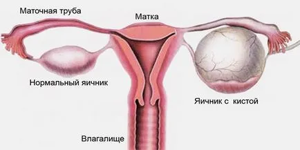 Lichidul din pelvis asupra cauzelor cu ultrasunete și tratamentul stazei (tratament) Lichidul în pelvis la ultrasunete tratament și provoacă stagnare