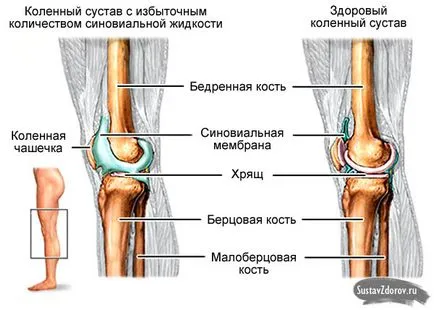 Lichidul din cauzele articulației genunchiului tratament, simptome, diagnostic (lichid) Lichidul din cauzele articulația genunchiului și de tratament, simptomele, diagnosticul