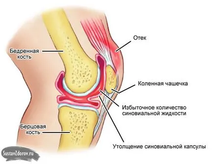 Lichidul din genunchi cauze comune și tratament, simptome, diagnostic (cauze) Lichidul din cauzele articulația genunchiului și de tratament, simptomele, diagnosticul