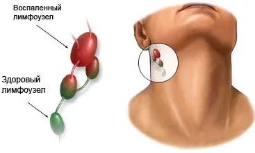 nodul limfatic inflamată decât vindecarea
