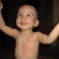 Erupții cutanate și mâncărime, care este