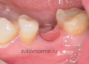 Proteza sau implantare